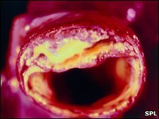 Atherosclerosis