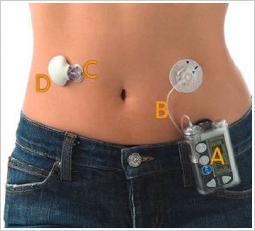 Insulin_pump