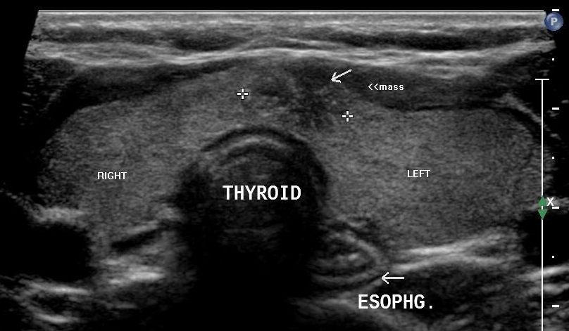 thyroid nodule ultrasound